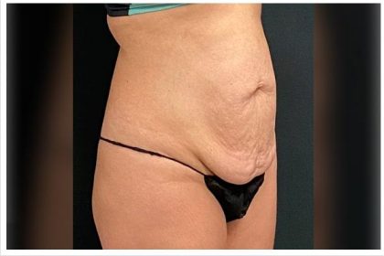 Abdominoplasty Before & After Patient #15916