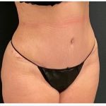 Abdominoplasty Before & After Patient #15916