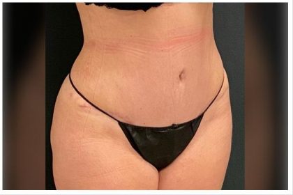 Abdominoplasty Before & After Patient #15916