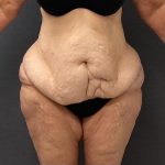 Abdominoplasty Before & After Patient #15917