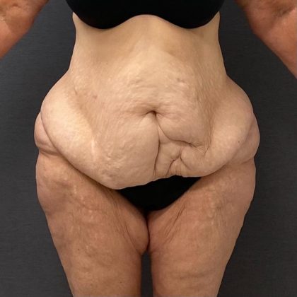 Abdominoplasty Before & After Patient #15917