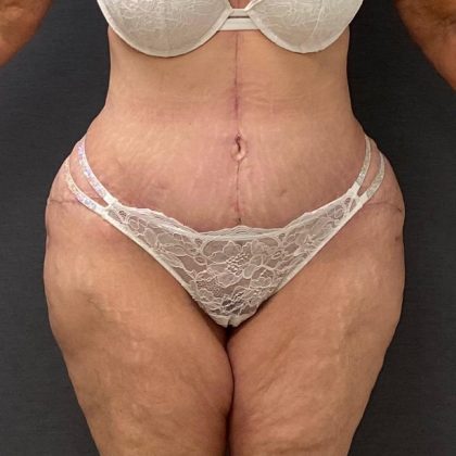Abdominoplasty Before & After Patient #15917