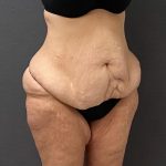 Abdominoplasty Before & After Patient #15917
