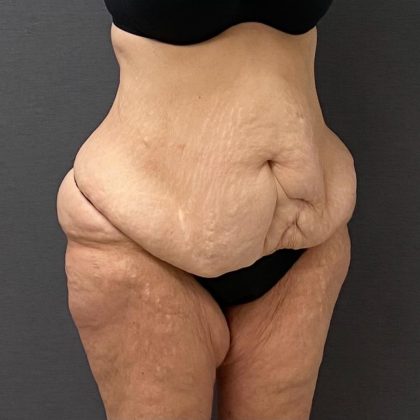 Abdominoplasty Before & After Patient #15917