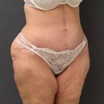 Abdominoplasty Before & After Patient #15917