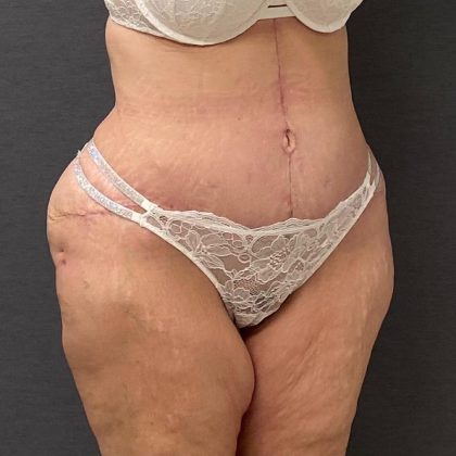 Abdominoplasty Before & After Patient #15917