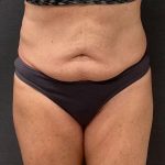 Abdominoplasty Before & After Patient #15918