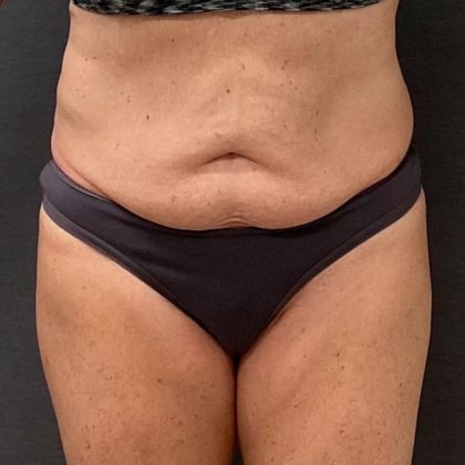 Abdominoplasty Before & After Patient #15918