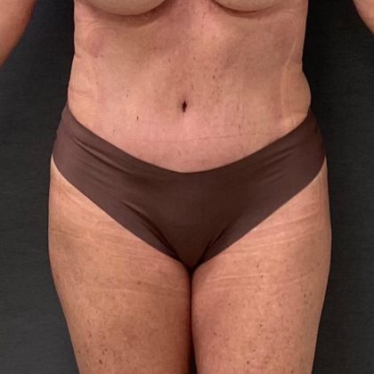 Abdominoplasty Before & After Patient #15918