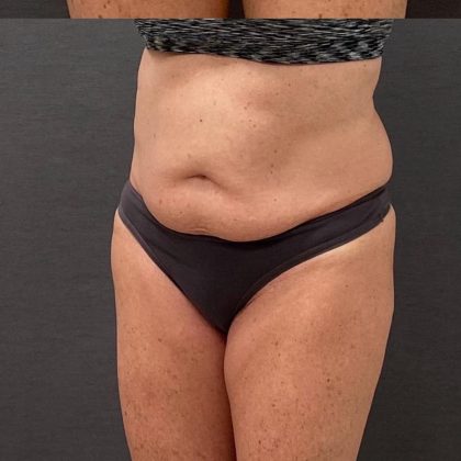 Abdominoplasty Before & After Patient #15918