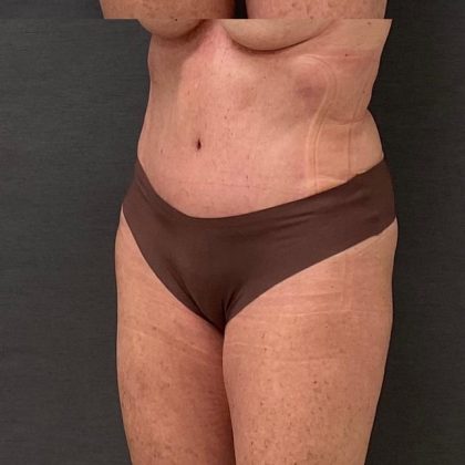 Abdominoplasty Before & After Patient #15918