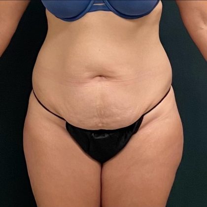 Abdominoplasty Before & After Patient #15919
