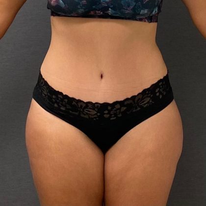 Abdominoplasty Before & After Patient #15919