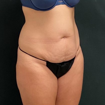 Abdominoplasty Before & After Patient #15919