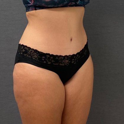 Abdominoplasty Before & After Patient #15919