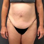 Abdominoplasty Before & After Patient #15920