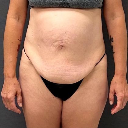 Abdominoplasty Before & After Patient #15920