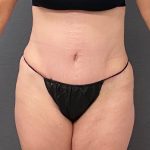 Abdominoplasty Before & After Patient #15920