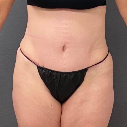 Abdominoplasty Before & After Patient #15920