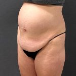 Abdominoplasty Before & After Patient #15920