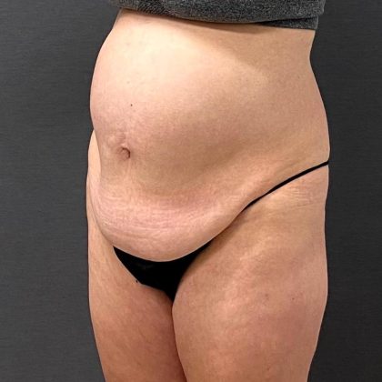Abdominoplasty Before & After Patient #15920