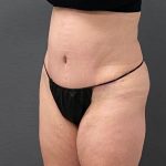 Abdominoplasty Before & After Patient #15920