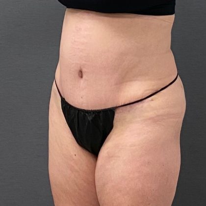 Abdominoplasty Before & After Patient #15920
