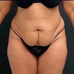 Abdominoplasty Before & After Patient #15921
