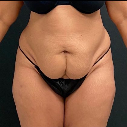 Abdominoplasty Before & After Patient #15921