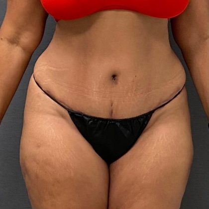 Abdominoplasty Before & After Patient #15921