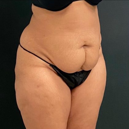 Abdominoplasty Before & After Patient #15921