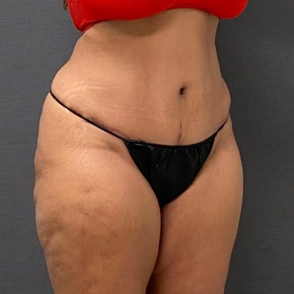Abdominoplasty Before & After Patient #15921