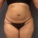 Abdominoplasty Before & After Patient #15922