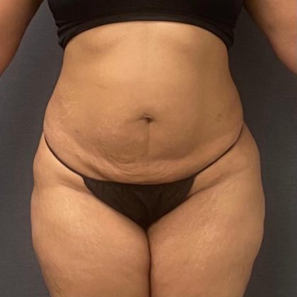Abdominoplasty Before & After Patient #15922