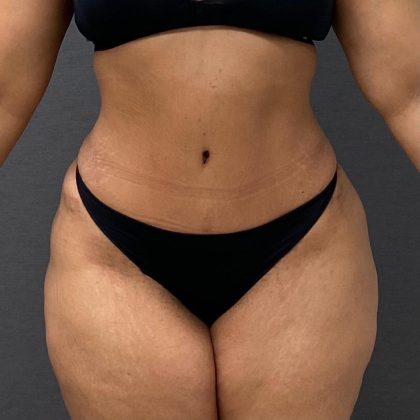 Abdominoplasty Before & After Patient #15922