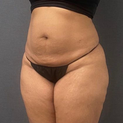 Abdominoplasty Before & After Patient #15922