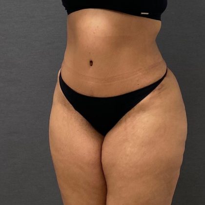 Abdominoplasty Before & After Patient #15922