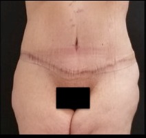Abdominoplasty Before & After Patient #15905