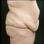 Abdominoplasty Before & After Patient #15905
