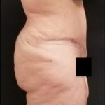 Abdominoplasty Before & After Patient #15905