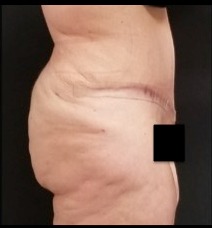 Abdominoplasty Before & After Patient #15905