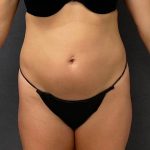 Abdominoplasty Before & After Patient #15923