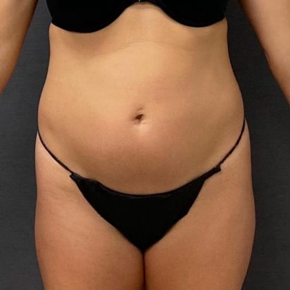 Abdominoplasty Before & After Patient #15923