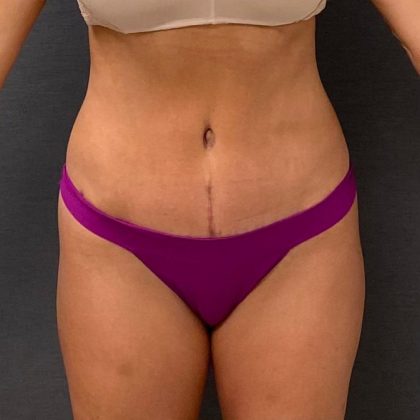 Abdominoplasty Before & After Patient #15923
