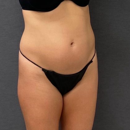 Abdominoplasty Before & After Patient #15923