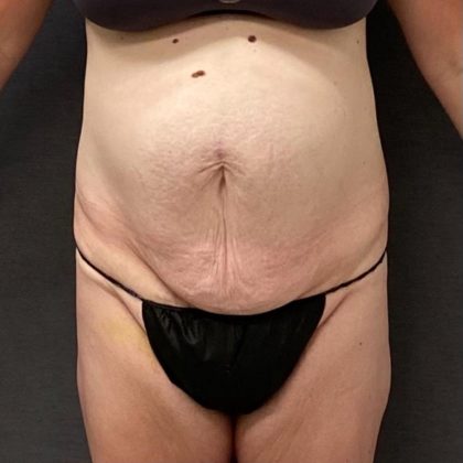 Abdominoplasty Before & After Patient #15924