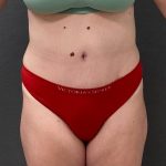 Abdominoplasty Before & After Patient #15924