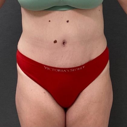 Abdominoplasty Before & After Patient #15924
