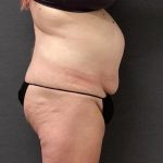 Abdominoplasty Before & After Patient #15924