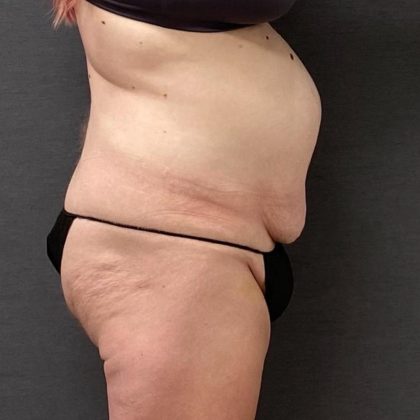 Abdominoplasty Before & After Patient #15924